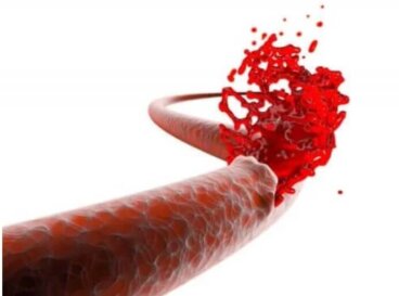Οι κίνδυνοι της μετεγχειρητικής αιμορραγίας