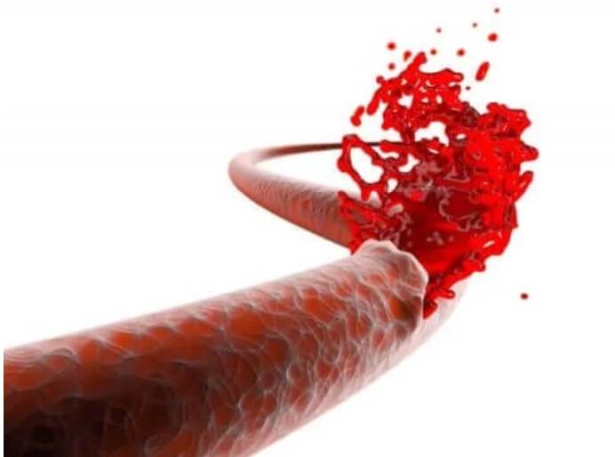 Οι κίνδυνοι της μετεγχειρητικής αιμορραγίας