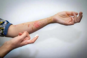 Επιφανειακό έγκαυμα: Πώς να το αντιμετωπίσετε