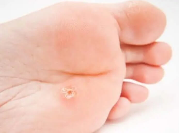 Κονδυλώματα στα πέλματα: Χαρακτηριστικά και θεραπεία