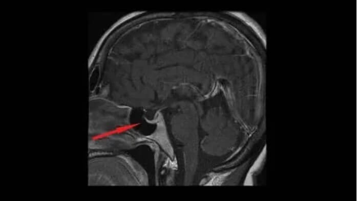 Τι είναι το αδένωμα της υπόφυσης; Τι πρέπει να ξέρετε