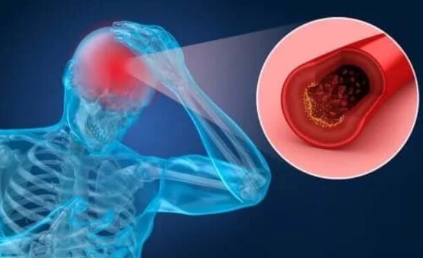 Εγκεφαλικό επεισόδιο: Παράγοντες και συμπτώματα