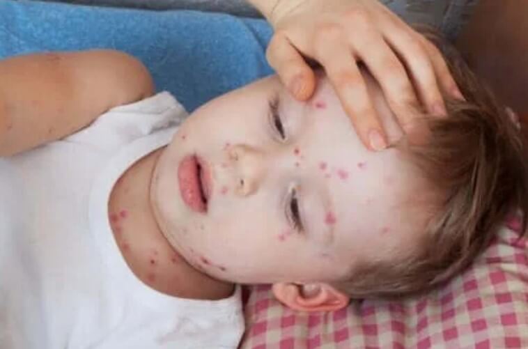 Πώς να θεραπεύσετε την κνίδωση στα παιδιά