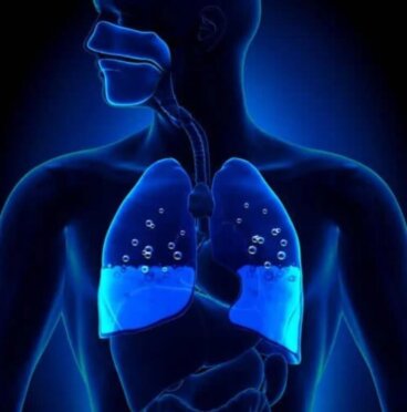 Πνευμονικό οίδημα: Συμπτώματα και αιτίες
