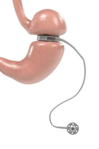 Ρυθμιζόμενος γαστρικός δακτύλιος: Χρήσεις και χαρακτηριστικά