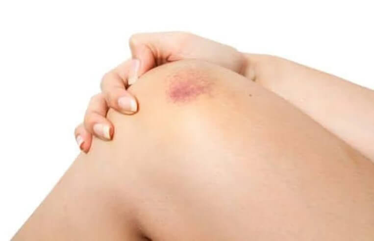 Εκχύμωση: Τι είναι και τι πρέπει να προσέξετε