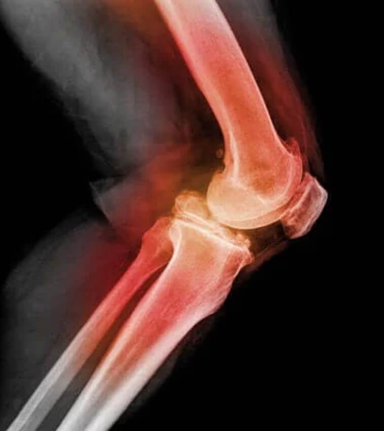 Εξάρθρωση του γόνατος: Όλα όσα πρέπει να ξέρετε