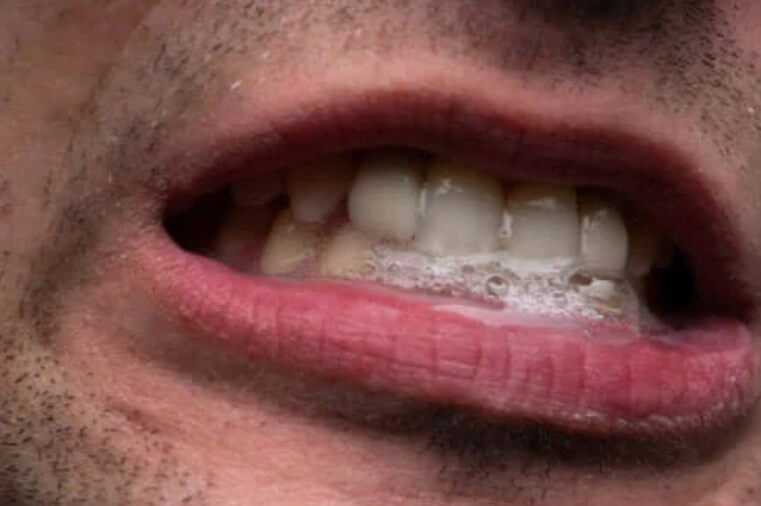 Έντονη σιελόρροια: Τα χαρακτηριστικά και η θεραπεία