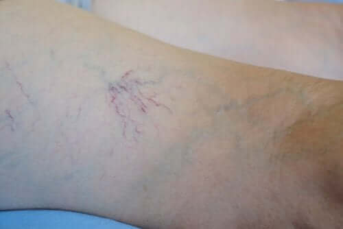 Venoruton: Τα χαρακτηριστικά και οι χρήσεις του