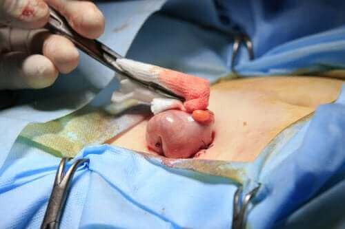 Όσα πρέπει να ξέρετε για μια κολοστομία