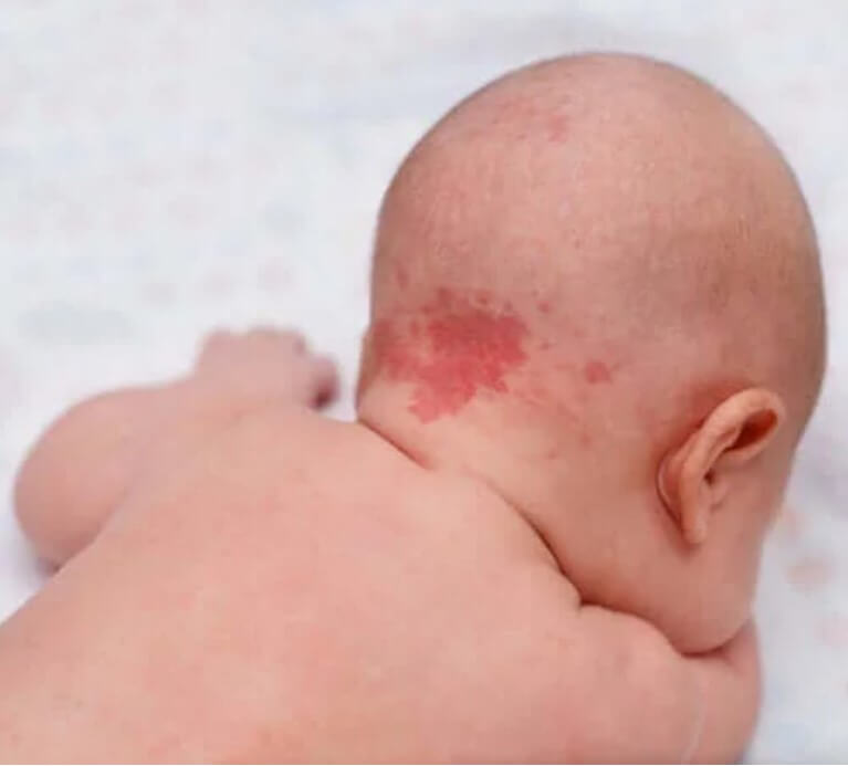 Σημάδια γέννησης και κρεατοελιές: Γιατί εμφανίζονται;