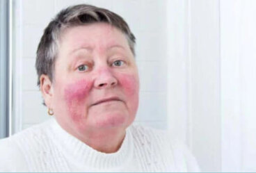 Ροδόχρους ακμή: Ποιες είναι οι αιτίες και τα συμπτώματα