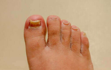 Ονυχομυκητίαση χεριών και ποδιών: Λειτουργούν οι φυσικές θεραπείες;