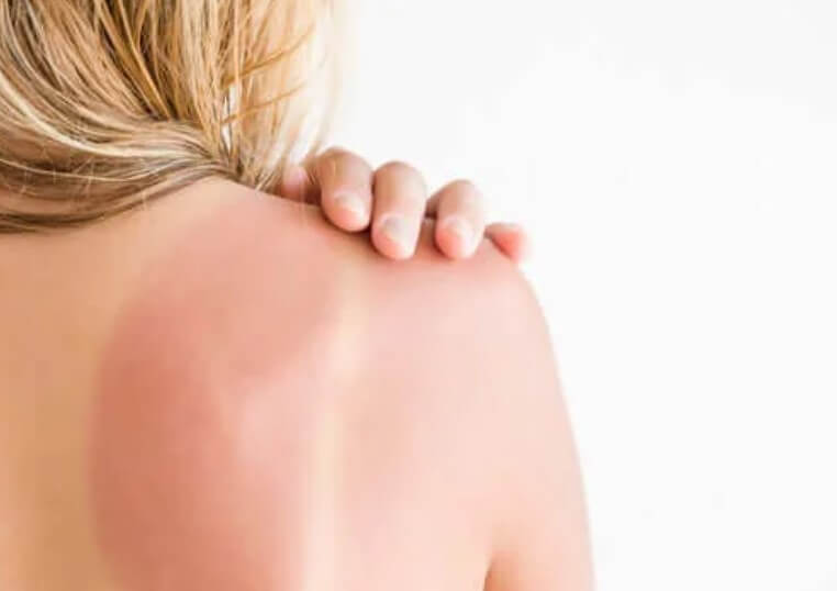 Ηλιακό ερύθημα: Συστάσεις και πώς να το φροντίσετε