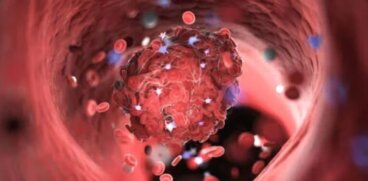 Τριάδα του Virchow: Τι είναι και πώς γίνεται η διάγνωση