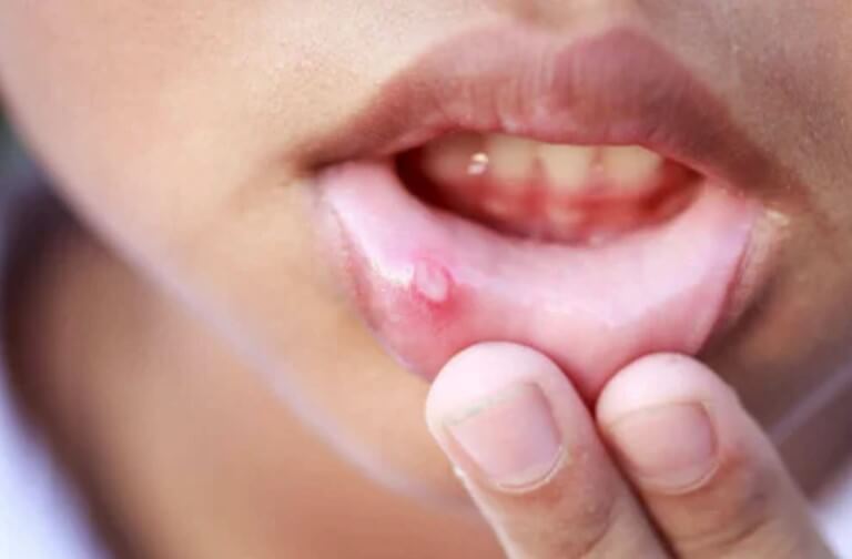 Άφθες στα παιδιά: Πώς μπορείτε να τις θεραπεύσετε γρήγορα;