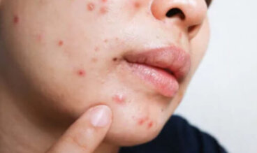 Ισοτρετινοΐνη για την ακμή: Οφέλη και παρενέργειες