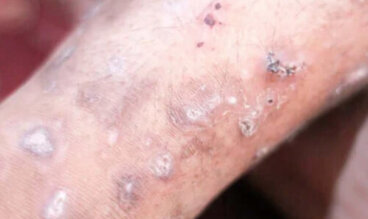 Αιτίες, συμπτώματα και θεραπείες για τη ψώρα