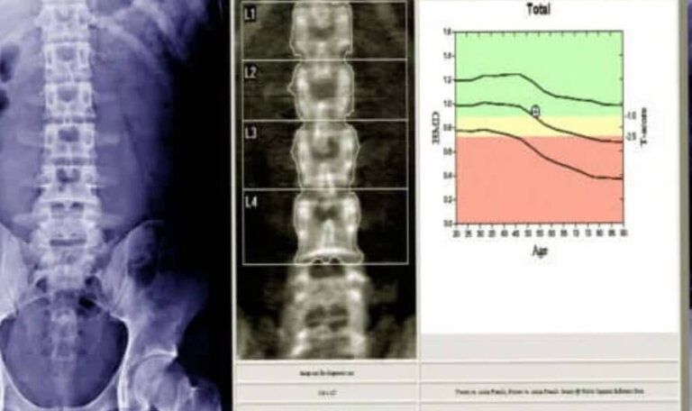 Πυκνομετρία των οστών: Τι είναι και πώς λειτουργεί;