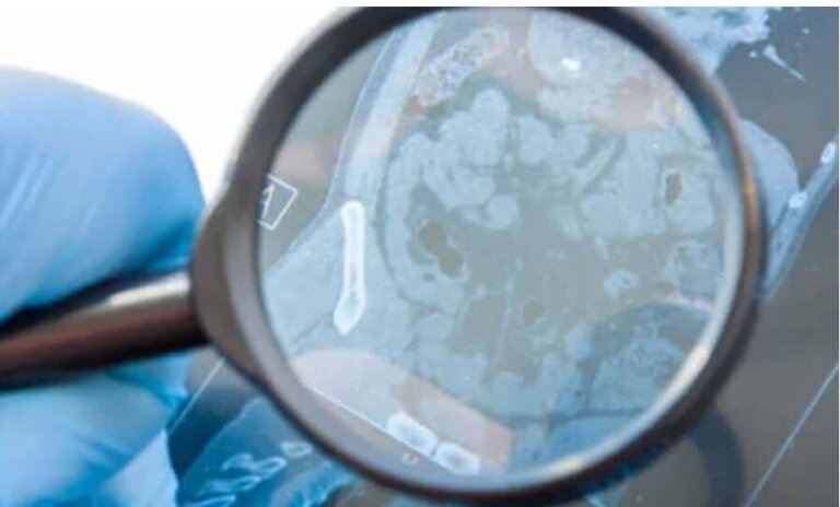 Τι είναι το γαστρεντερικό συρίγγιο και τι το προκαλεί;