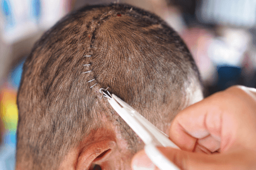 Τι είναι η κρανιοτομή και πότε είναι απαραίτητη;