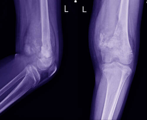 Χαρακτηριστικά του οστεοσαρκώματος στα παιδιά
