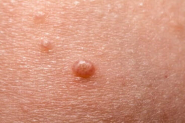Molluscum Contagiosum: Τι είναι και πώς εμφανίζεται