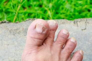 Μύκητες του δέρματος: 5 τύποι και πώς να τους αναγνωρίσετε