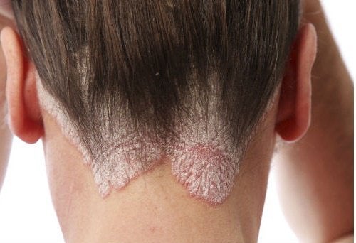 Δακτυλίτιδα του τριχωτού της κεφαλής: Πώς να την αντιμετωπίσετε