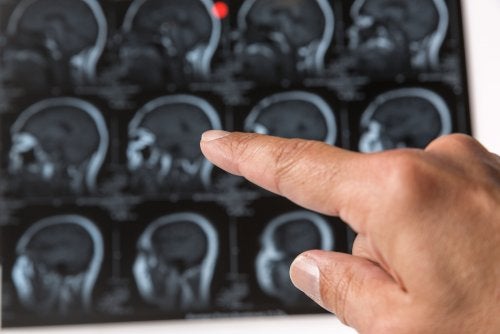 Θα μπορούσαν τα εξογκώματα στο κεφάλι να είναι όγκοι;