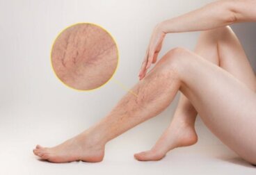 Οι 10 καλύτερες θεραπείες για τους κιρσούς