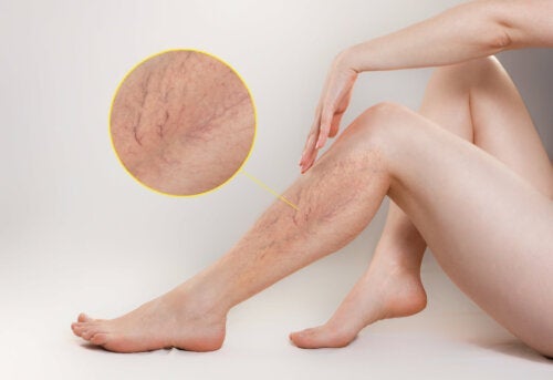 Οι 10 καλύτερες θεραπείες για τους κιρσούς