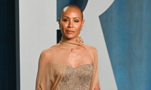 Γυροειδής αλωπεκία: Η ασθένεια της Pinkett Smith