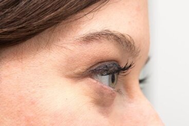 Αιτίες και θεραπεία για τους μαύρους κύκλους στα μάτια