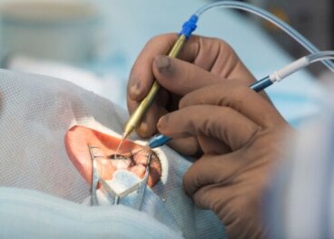 8 παρενέργειες από τη χειρουργική επέμβαση καταρράκτη