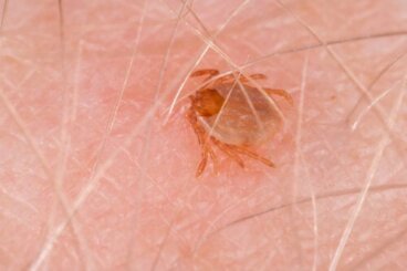 Πυρετός των Βραχωδών Ορέων: Συμπτώματα και θεραπείες