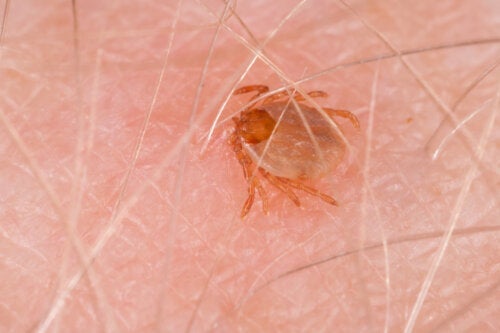 Πυρετός των Βραχωδών Ορέων: Συμπτώματα και θεραπείες