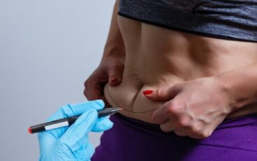 BodyTite, η τεχνολογία για τη μείωση της χαλαρότητας του σώματος