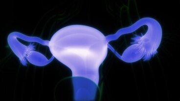 Δερμοειδείς κύστεις των ωοθηκών: Συμπτώματα και επιπλοκές