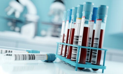 Τι είναι η εξέταση GGT και τι σημαίνουν τα αποτελέσματα;