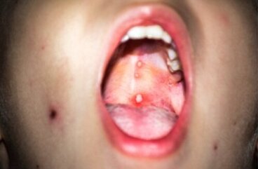 Ουλικοστοματίτιδα στα παιδιά: Τι είναι και τι να κάνετε