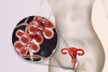Κίτρινο κολπικό έκκριμα: 5 αιτίες και θεραπεία